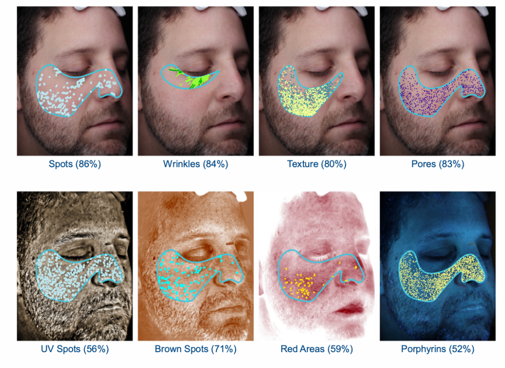 VISIA facial analysis views mapping spots, wrinkles, texture, pores, UV spots, brown spots, red areas and porphyrins