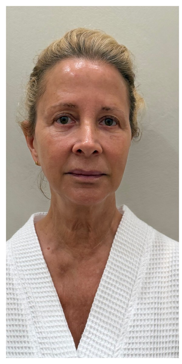 Before XERF treatment, front view