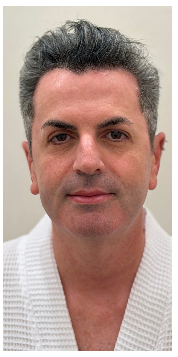 After XERF treatment, front view